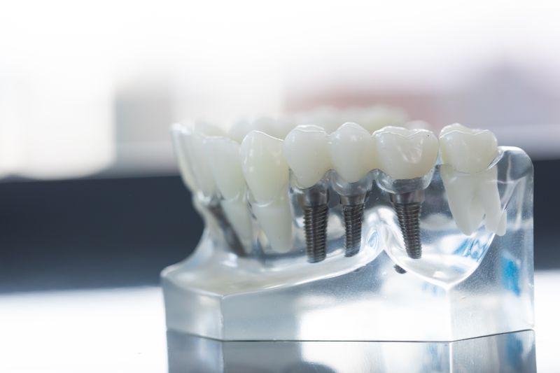 What Material Are Dental Implants Made Of?